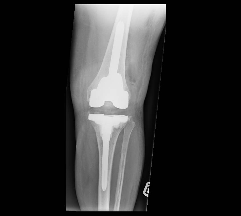 Revisiontkrlooseningap