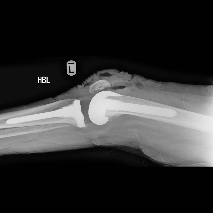 Revision Knee Surgery London Hip and Knee Surgeon