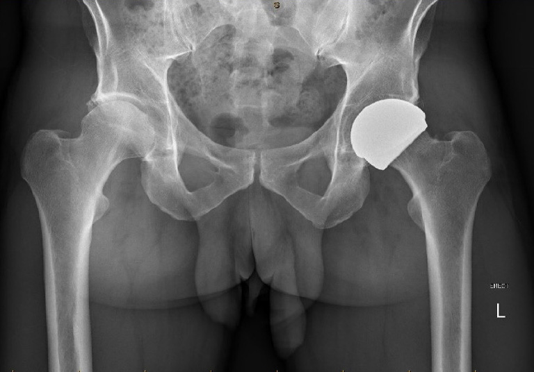 Hip Resurfacing Xray