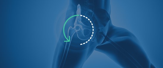 Hip Arthritis